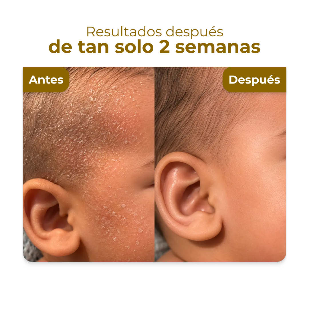 Crema miel para dermatitis