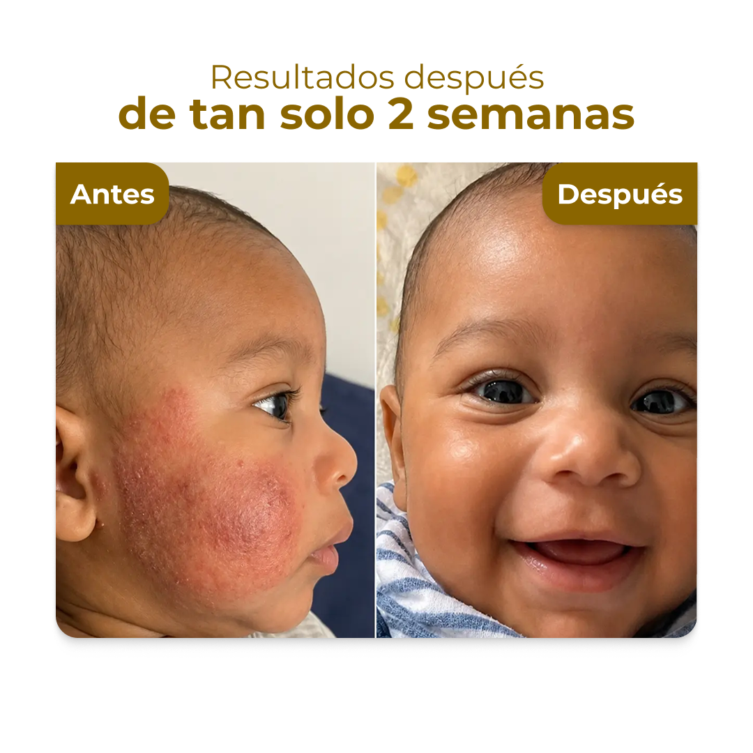 Crema miel para dermatitis