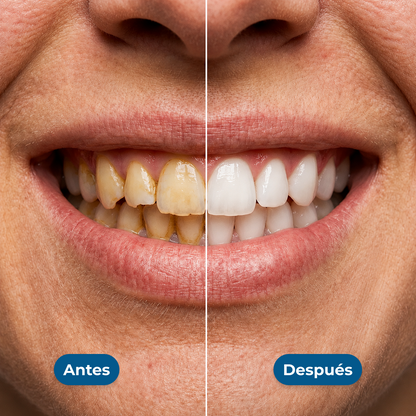 Blindaje Dental